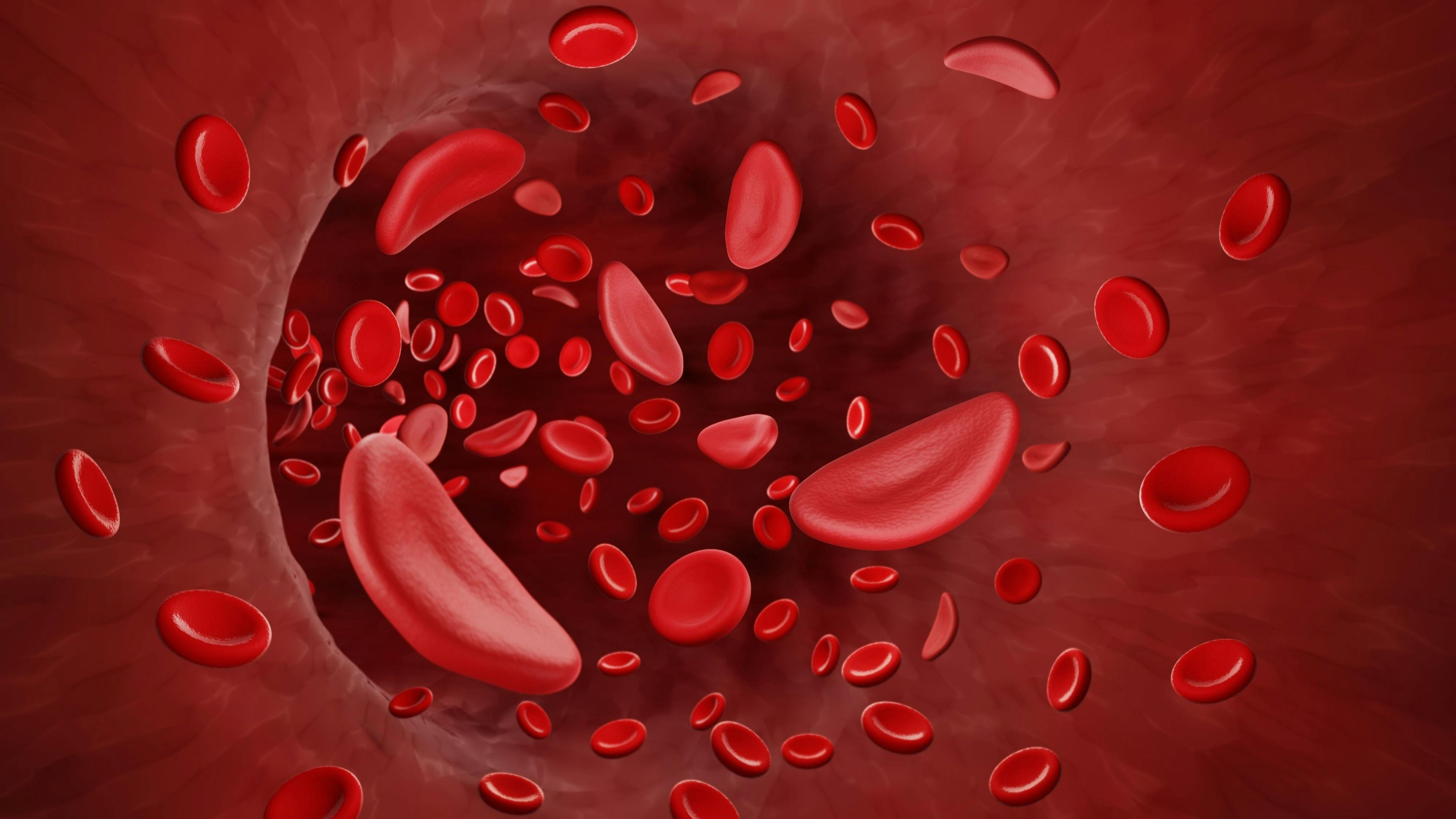 FDA Approves First Gene Therapies for Treatment in Patients With Sickle Cell Disease