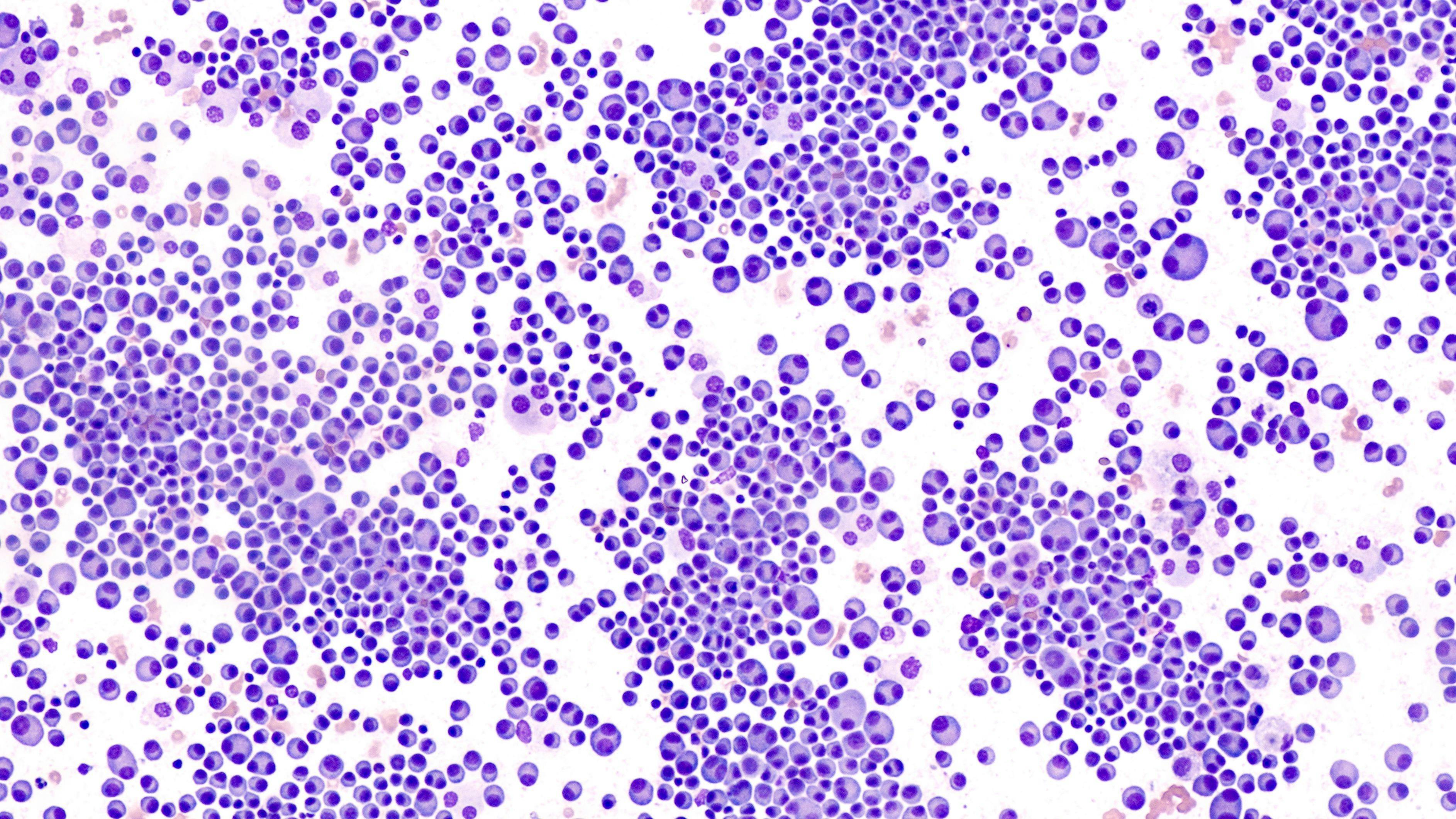 Bone marrow aspirate findings of patient with multiple myeloma / David A Litman - stock.adobe.com