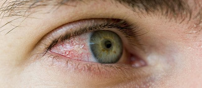 Tyrvaya Nasal Spray Treats Dry Eye Disease