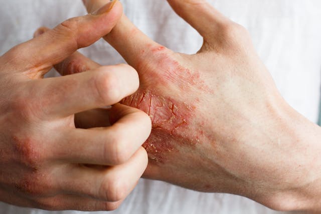 Chronic Hand Eczema Treatment Shows Positive Results in Phase 3 Trials