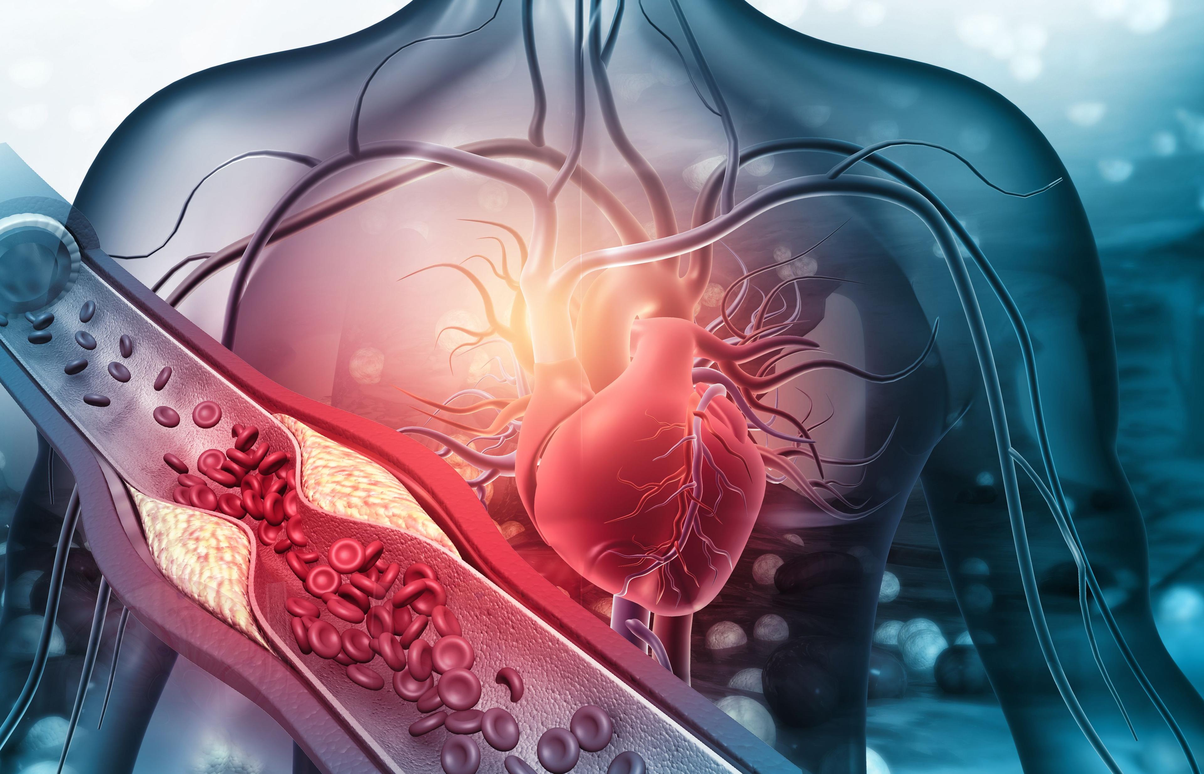 Human heart with blocked arteries / Rasi - stock.adobe.com