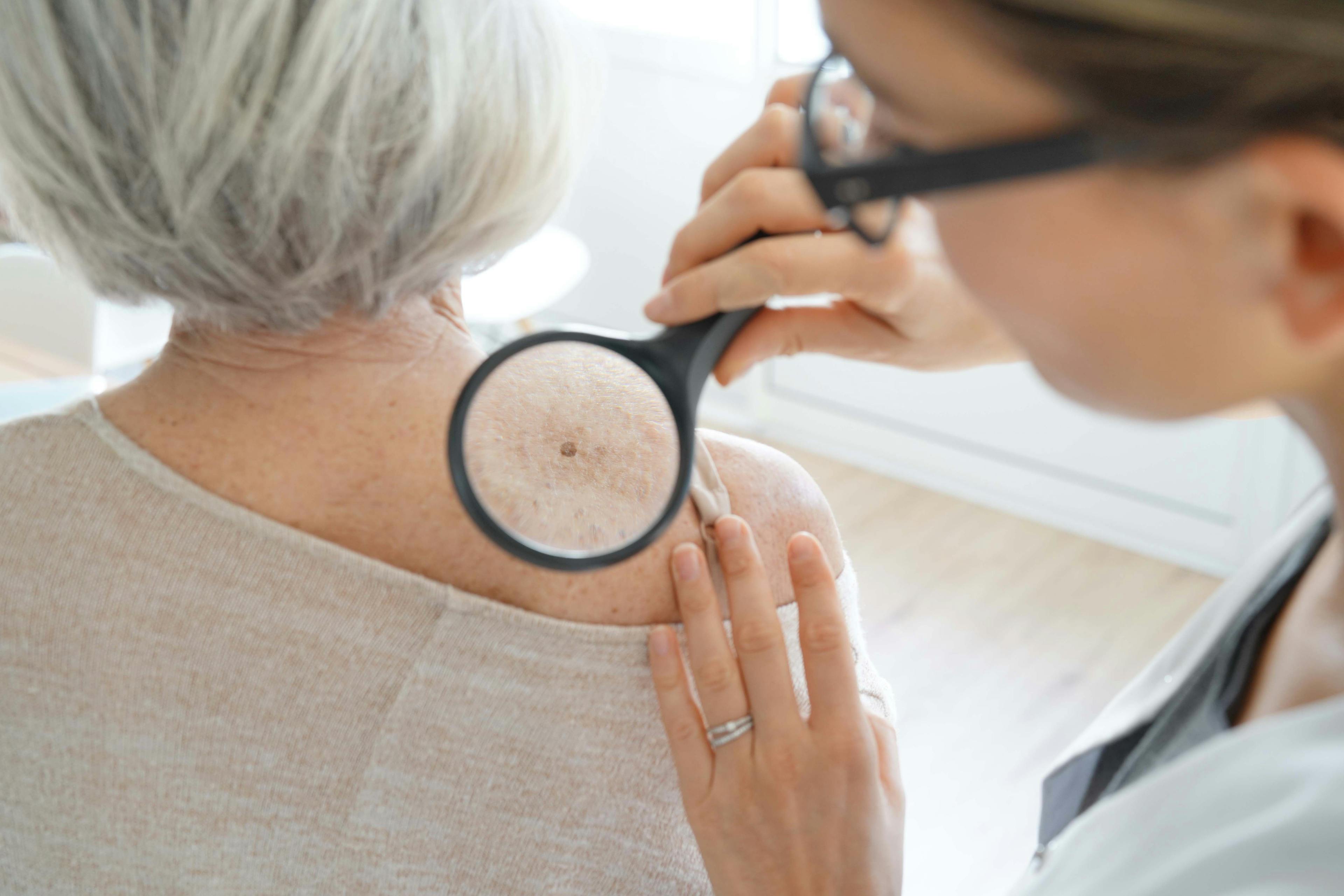 Dermatologic Follow-Up Adherence Associated with Reduced Melanoma Mortality