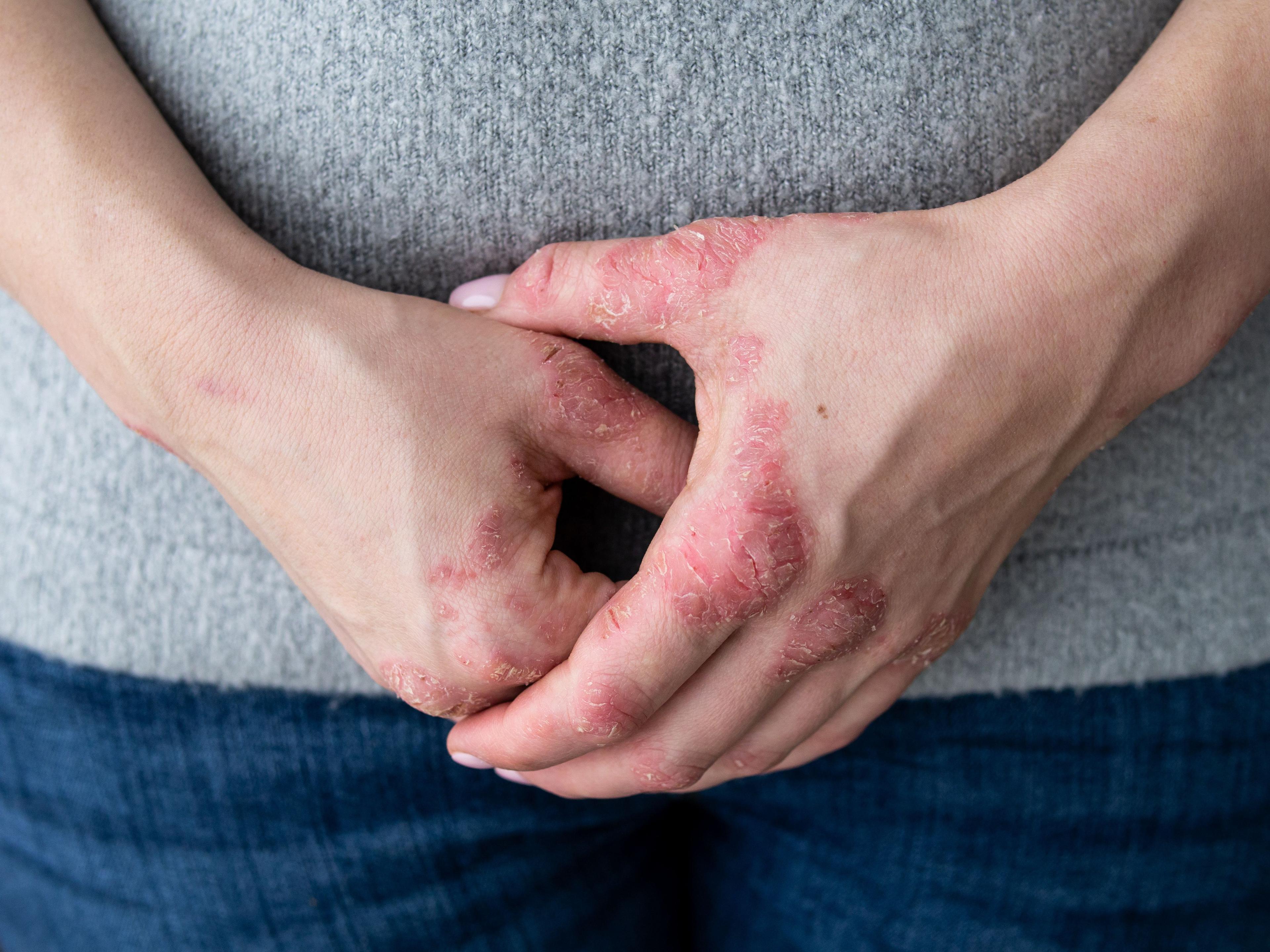 Chronic Hand Eczema Studies Show Condition is Common, Burdensome / IIIRusya - stock.adobe.com