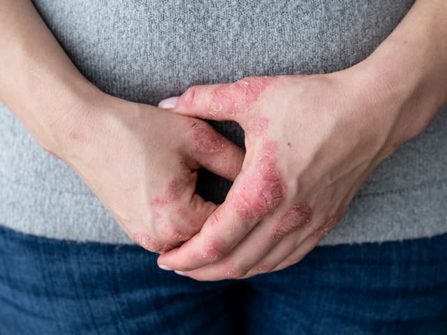 Chronic Hand Eczema Studies Show Condition is Common, Burdensome