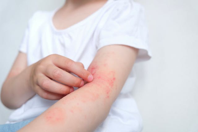 Roflumilast Cream Shows Durable Safety, Efficacy in Children with Atopic Dermatitis