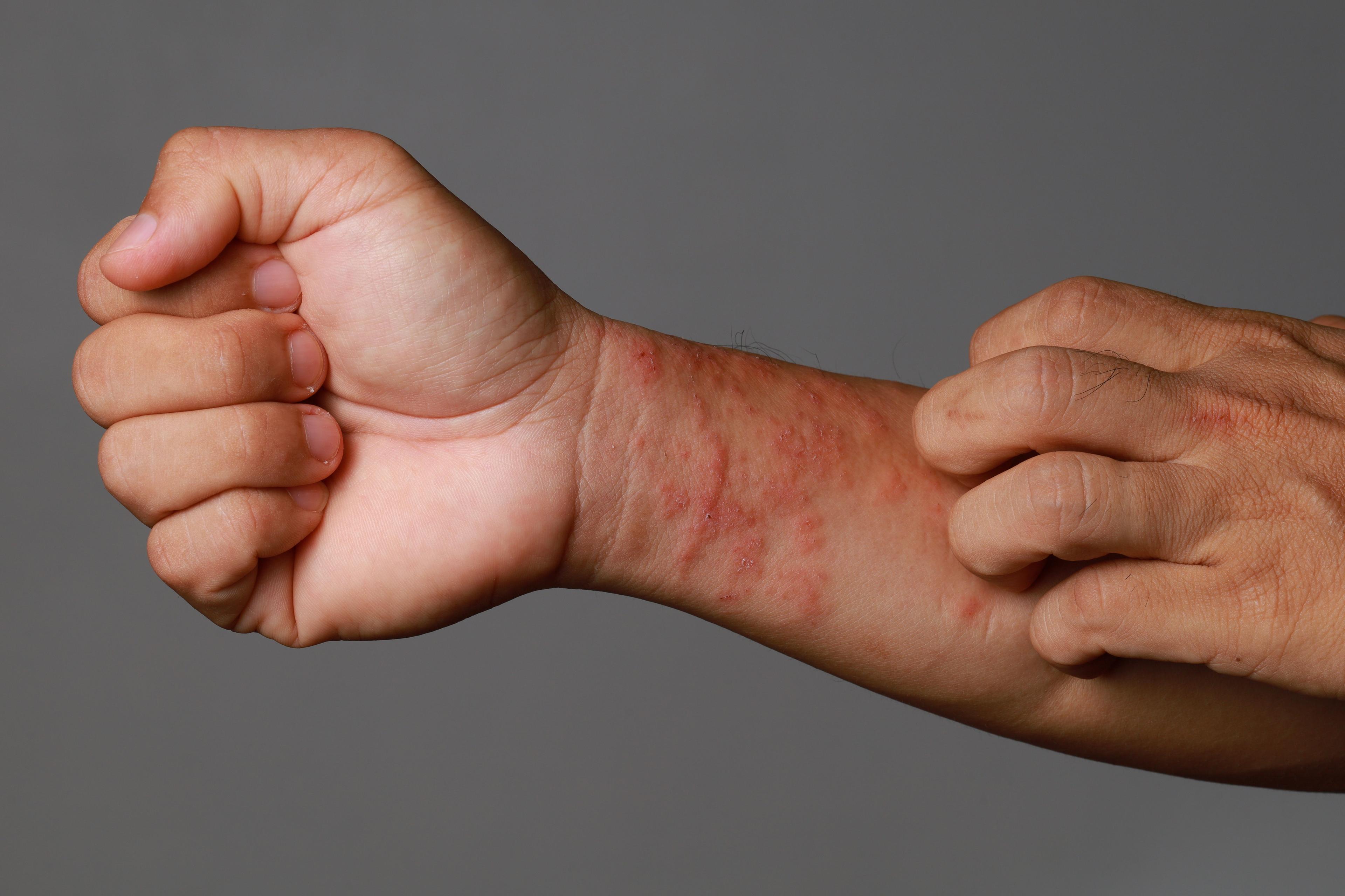 Atopc dermatitis on wrist / ltyuan - stock.adobe.com