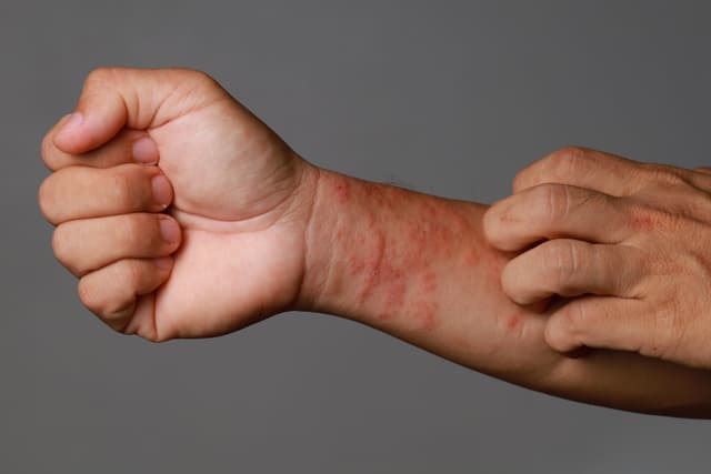 FDA Approves Lebrikizumab-lbkz for Moderate-to-Severe Atopic Dermatitis