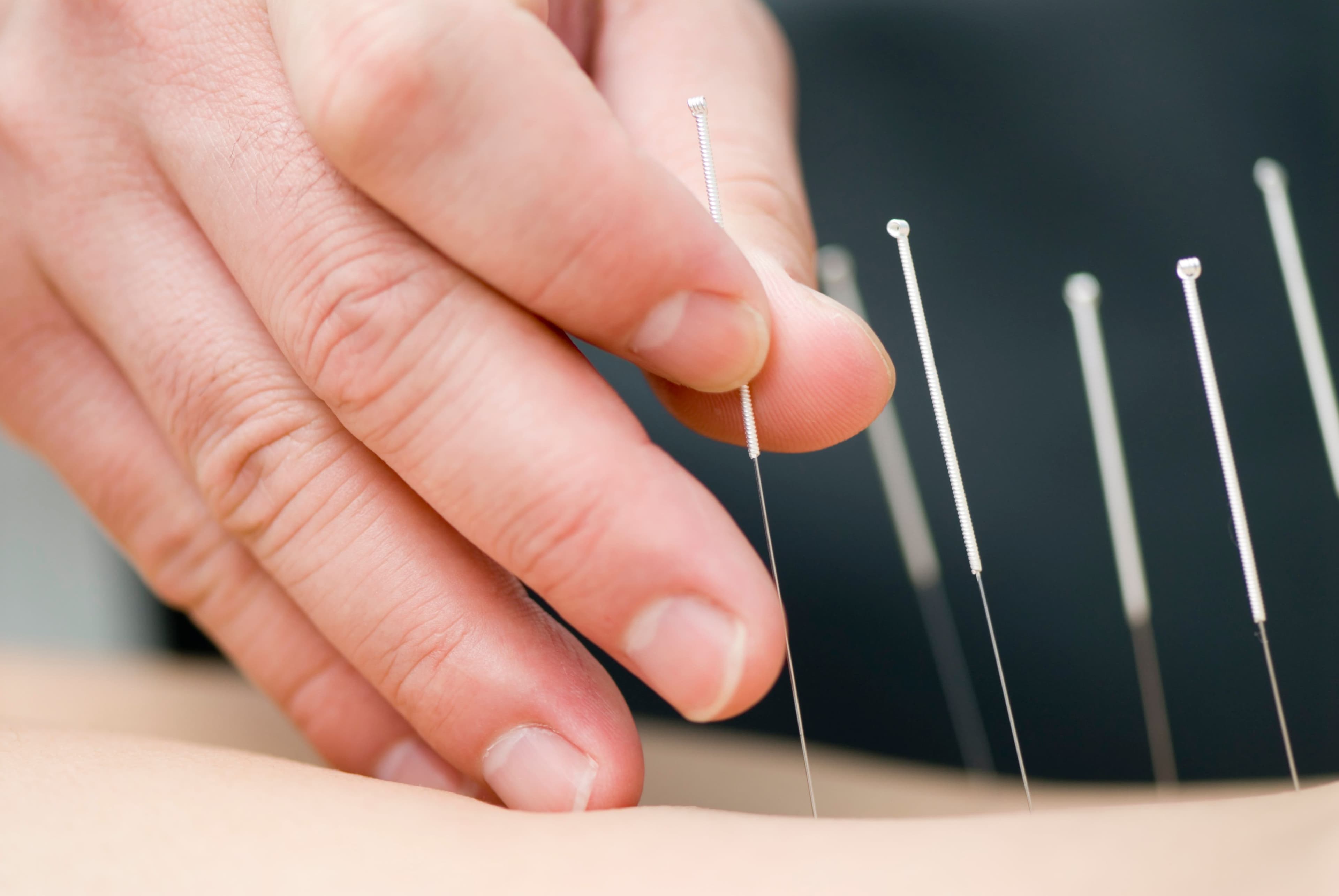 Acupuncture treatment / Max Tactic - stock.adobe.com