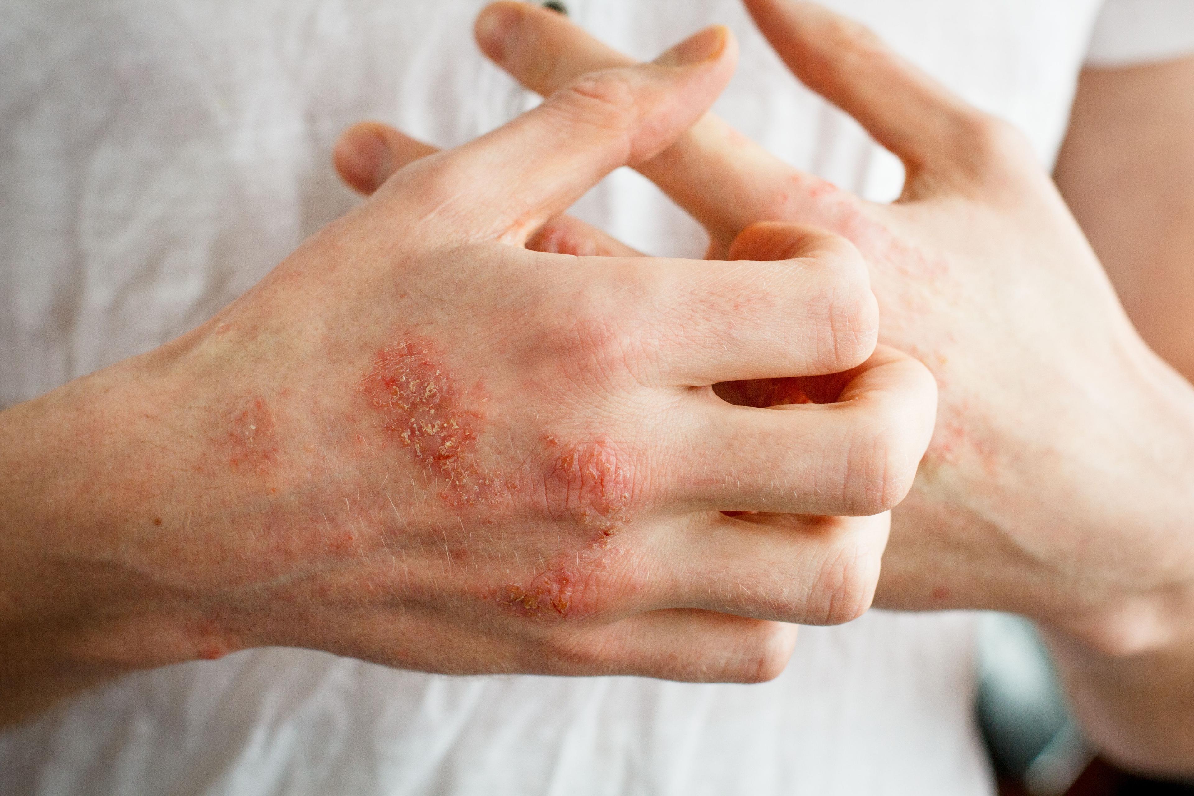 FDA Accepts NDA for Delgocitinib Cream to Treat Chronic Hand Eczema