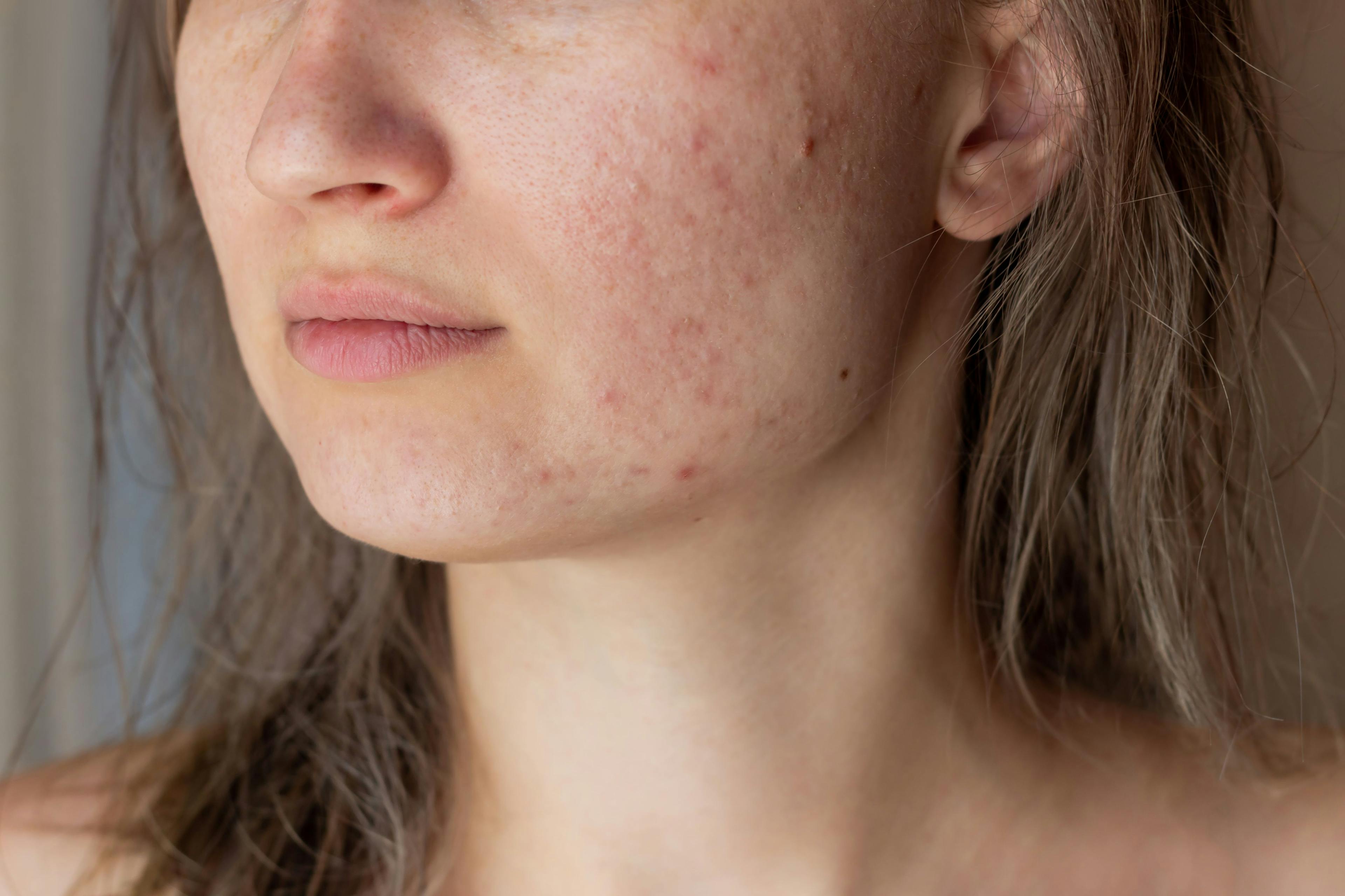 Mediterranean Diet, Omega-3 Supplements May Reduce Acne Severity 