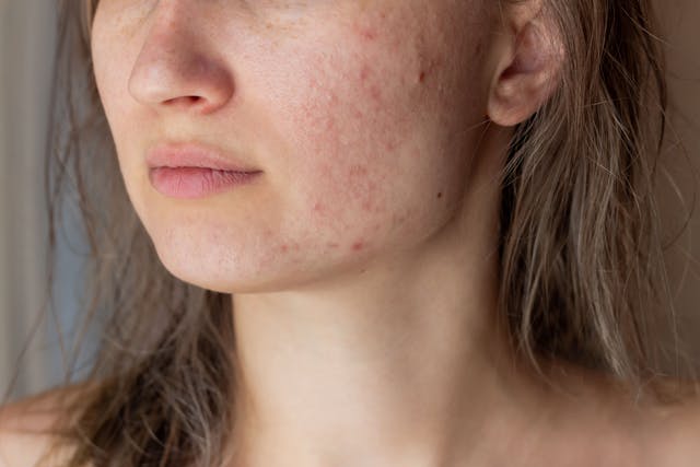 Mediterranean Diet, Omega-3 Supplements May Reduce Acne Severity 