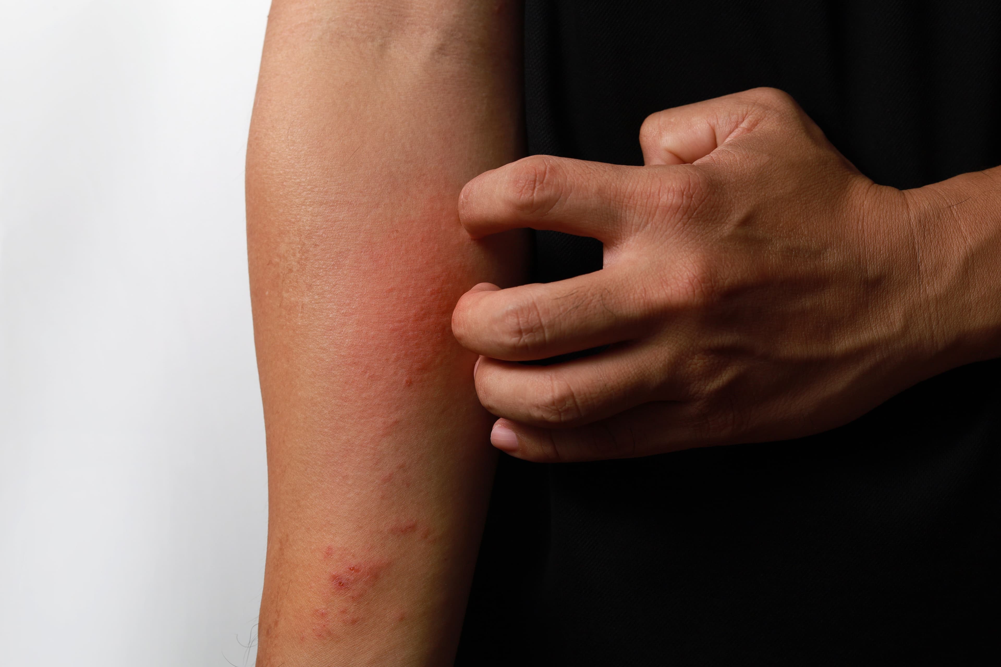 Dermatology Roundup: Atopic Dermatitis Treatments, Biosimilar Approval, and More