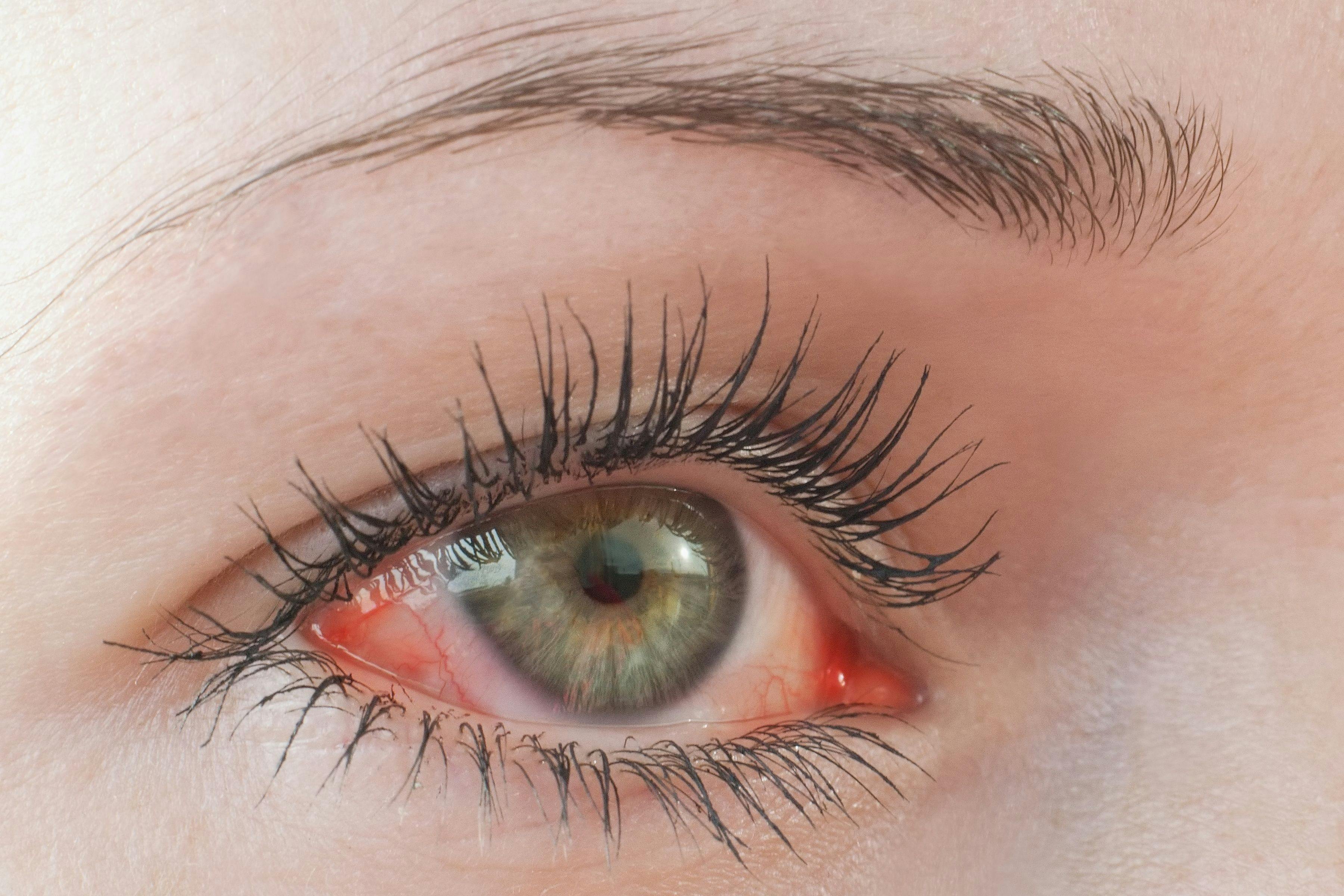 Slideshow: Vitamin D, Platelet-Rich Plasma for Treatment of Dry Eye Disease